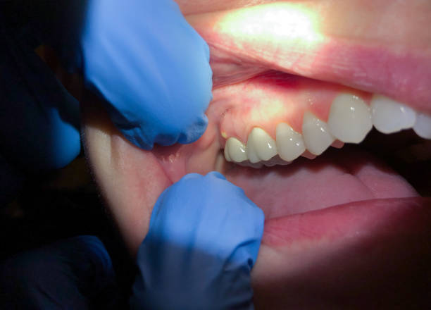Best Emergency Treatment for Dental Infections or Abscesses in Dakota Dunes, SD
